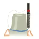 [TR-11] #TR بيرات تيبر راوند Tapered Round (TR-11, لوستر فرنسي).webp