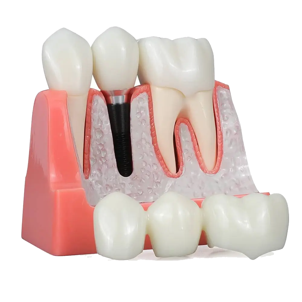 [004-0125] موديل اسنان زرعات  IMPLANT moniqan